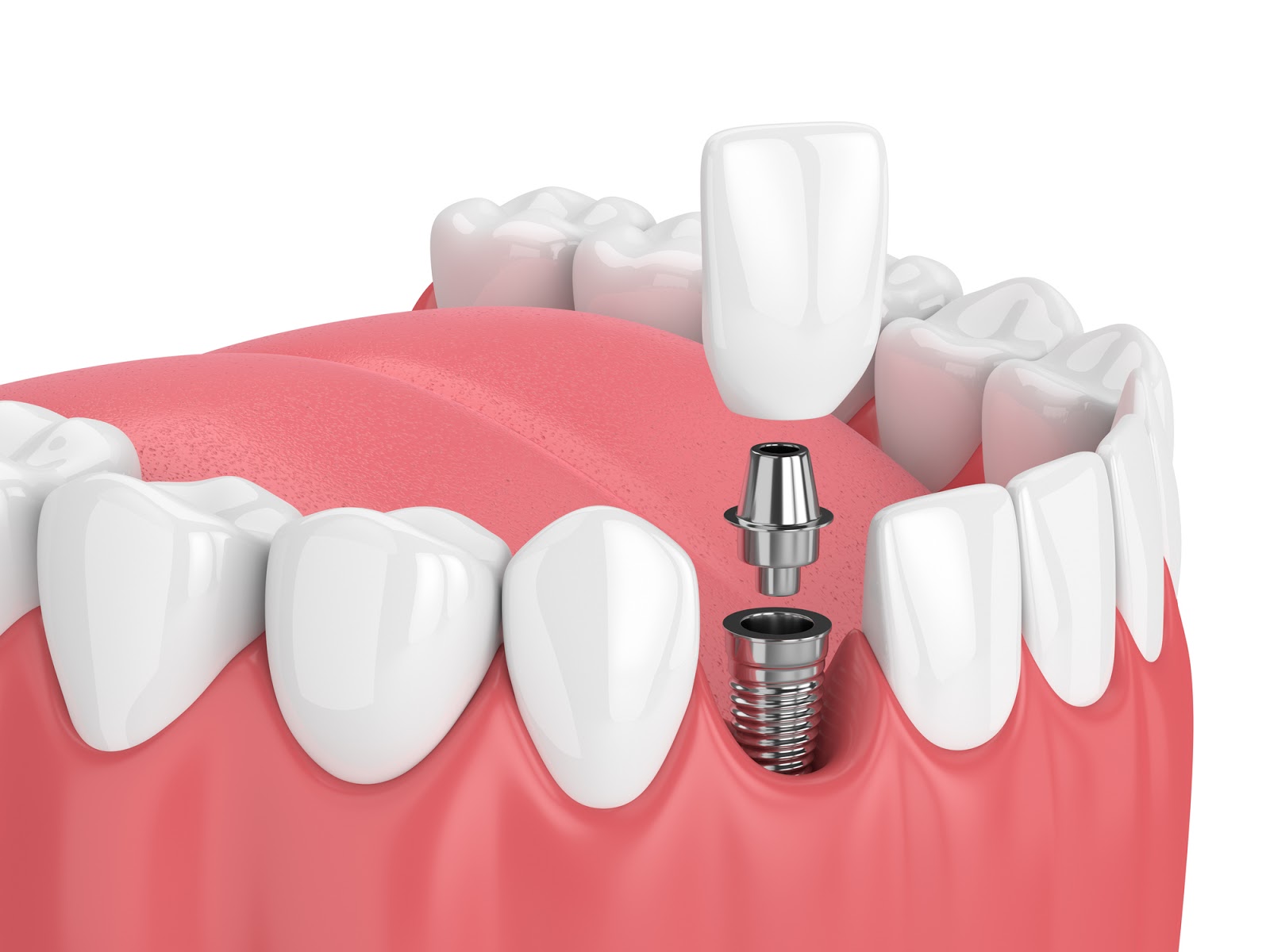 implantologia a carico immediato cos e e per chi e centri dentistici primo